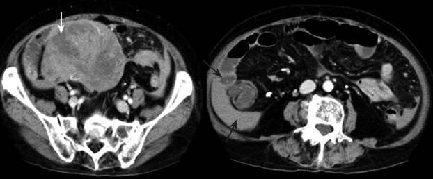 Tìm hiểu về khối u mô đệm đường tiêu hóa (GIST)