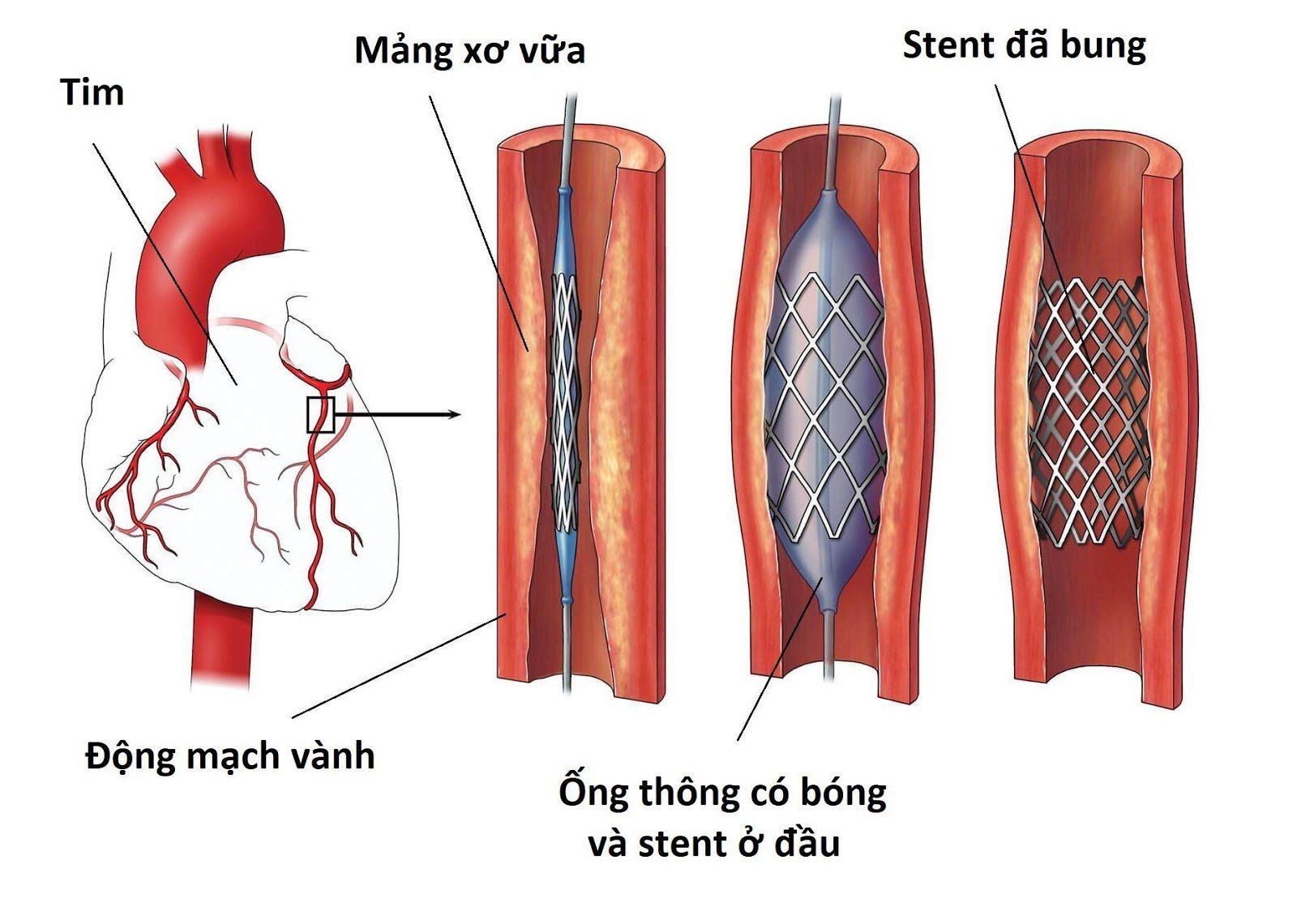 Cấu tạo của stent mạch vành