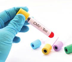 Bệnh do virus Cytomegalo gây điếc