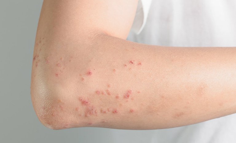 Kháng sinh Amoxicillin có dùng cho phụ nữ mang thai, cho con bú?