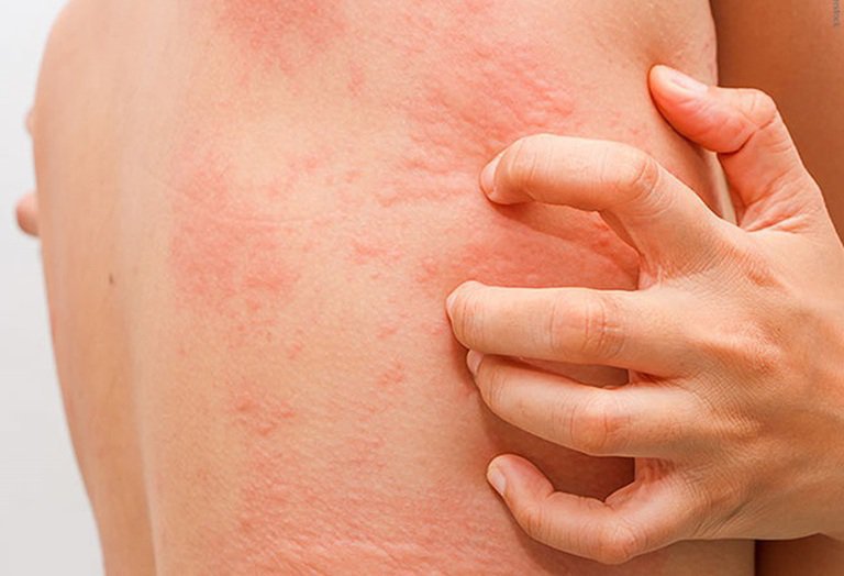 Thuốc Banophen: Công dụng, chỉ định và lưu ý khi dùng