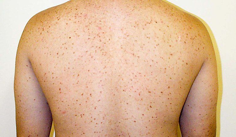 Hội chứng bệnh tế bào Mast (Mastocytosis) có nguy hiểm?