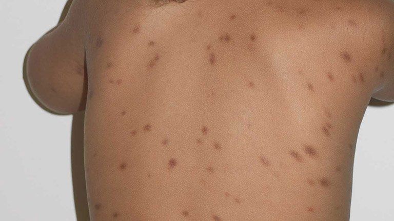 Hội chứng bệnh tế bào Mast (Mastocytosis) có nguy hiểm?