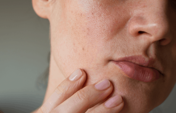 Thuốc Benzaclin: Công dụng, chỉ định và lưu ý khi dùng