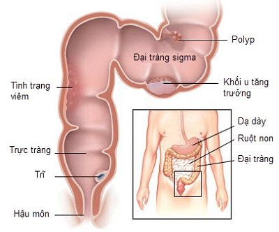 Những câu hỏi thường gặp về phẫu thuật cắt đại tràng