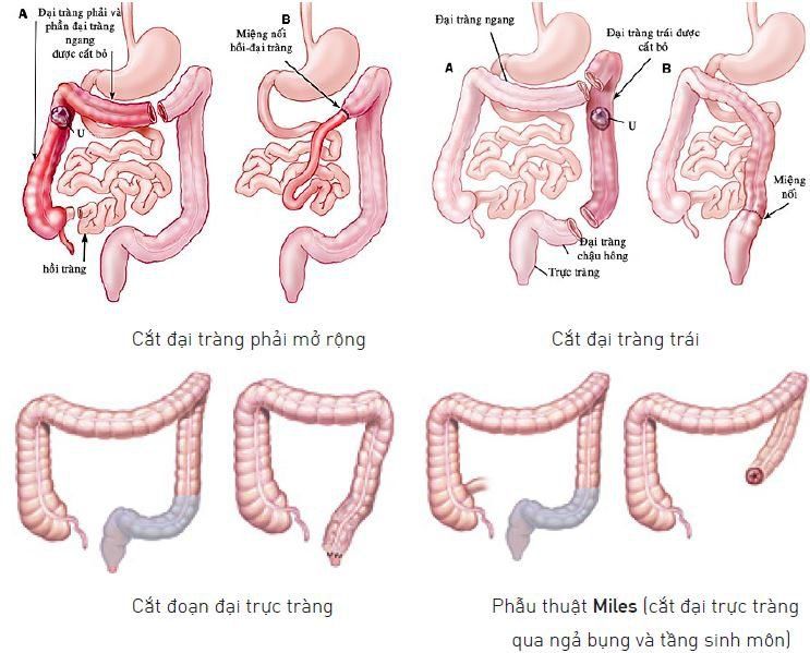 Những câu hỏi thường gặp về phẫu thuật cắt đại tràng