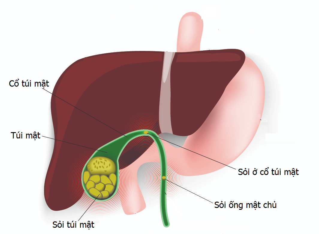 Các biến chứng của hội chứng ruột ngắn ở người lớn