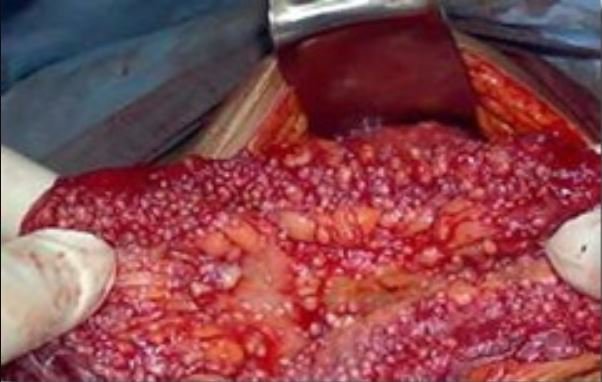 Nhiễm khuẩn ổ bụng: sinh lý bệnh, chẩn đoán và điều trị