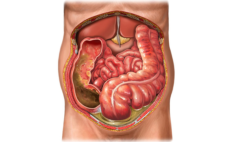 Nhiễm khuẩn ổ bụng: sinh lý bệnh, chẩn đoán và điều trị