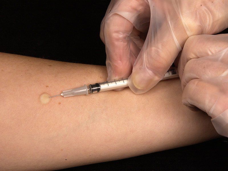 4 xét nghiệm dị ứng quan trọng: Lẩy da, áp da, huyết thanh, thử thách thuốc