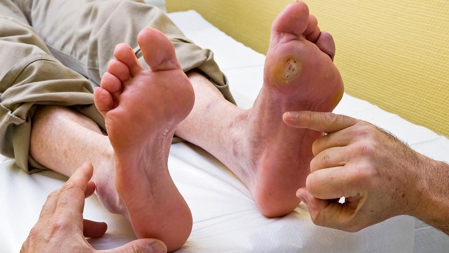 Kháng sinh điều trị loét bàn chân tiểu đường
