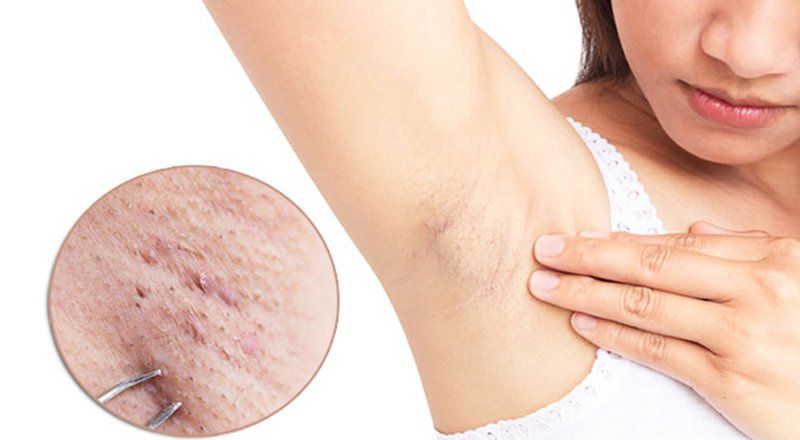 Nổi mụn ở nách: Nguyên nhân và cách điều trị