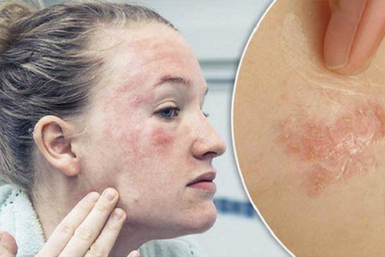 Thuốc Eumovate cream: Công dụng, liều dùng và lưu ý khi sử dụng