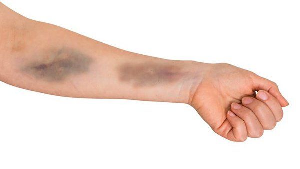 Thuốc Cyclophosphamide: Công dụng, chỉ định và lưu ý khi dùng