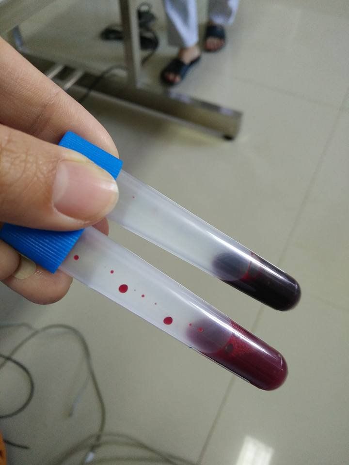 Xét nghiệm men Cholinesterase trong máu