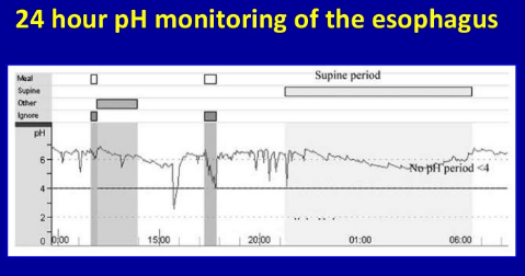 Ho kéo dài – Coi chừng nguyên nhân do trào ngược dạ dày thực quản