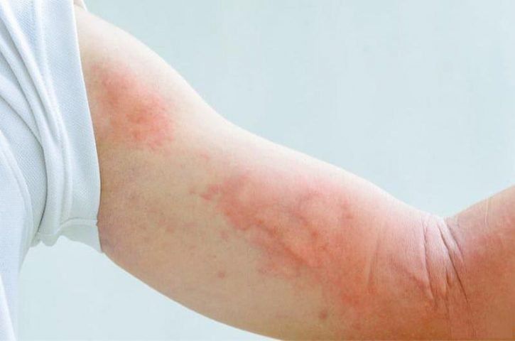 Thuốc Eletriptan: Công dụng, chỉ định và lưu ý khi dùng