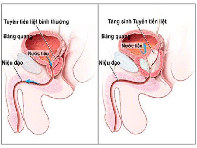 Làm thế nào để đi tiểu dễ hơn khi bị phì đại tuyến tiền liệt?