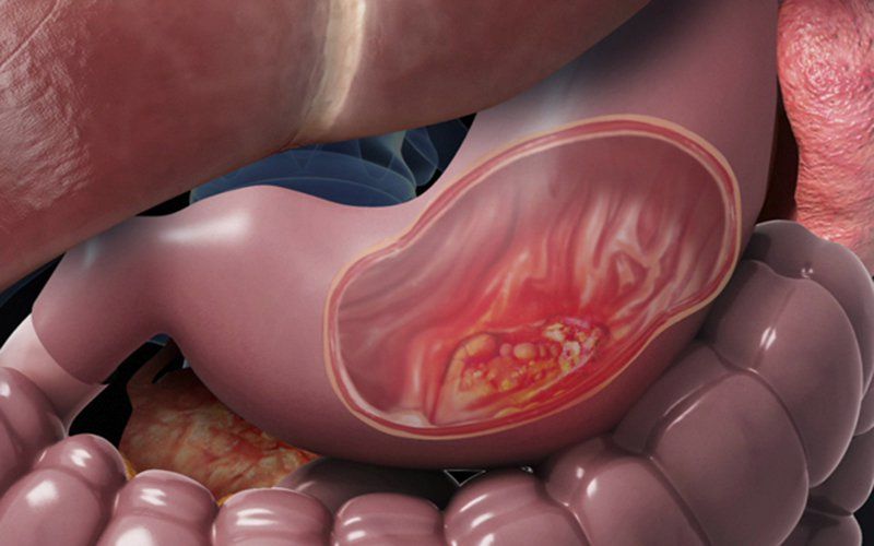 Thuốc Cytotec: Công dụng, chỉ định và lưu ý khi dùng