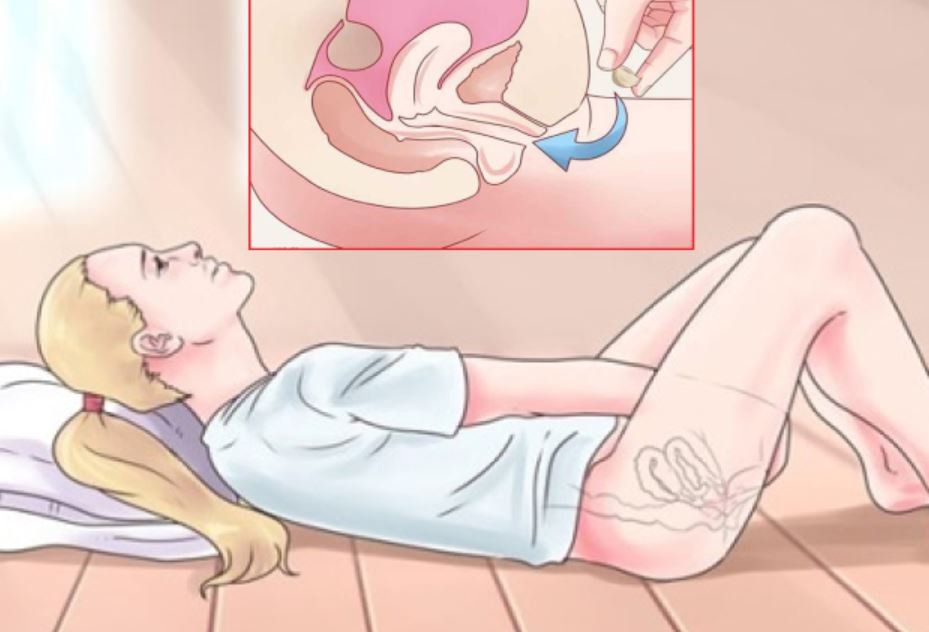 Tác dụng và những lưu ý khi dùng thuốc Cyclogest 400mg