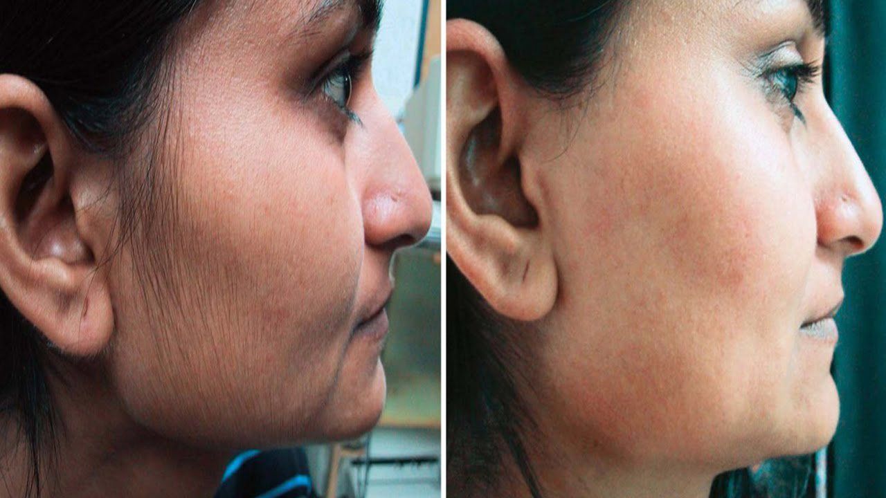 Thuốc Eflornithine: Công dụng, chỉ định và lưu ý khi dùng