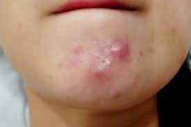 Loại bỏ mụn trứng cá bằng cách ăn uống lành mạnh hơn