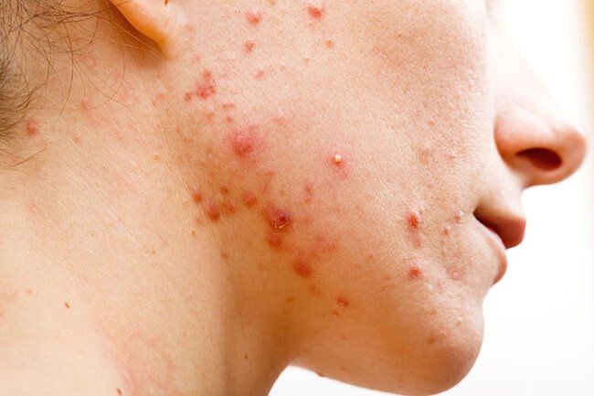 Xét nghiệm soi tươi tìm Demodex gây viêm da