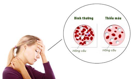 Thiếu máu do thiếu sắt phổ biến như thế nào?