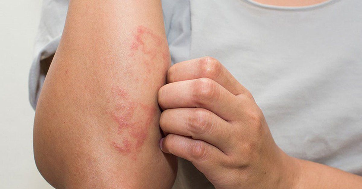 Thuốc Elidel: Công dụng, chỉ định và lưu ý khi dùng