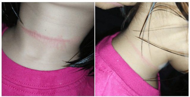 Hướng dẫn sơ cứu nạn nhân ngạt do treo cổ
