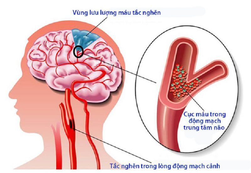 Bệnh Nhũn Não Có Chữa Được Không? Khám Phá Giải Pháp Và Tiên Lượng