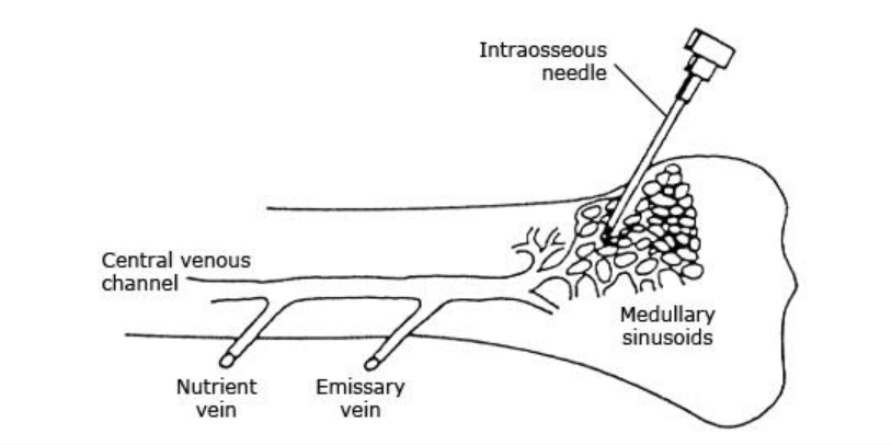 Kỹ thuật đặt đường truyền trong xương