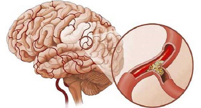 Hình ảnh MRI chảy máu não và nhồi máu não