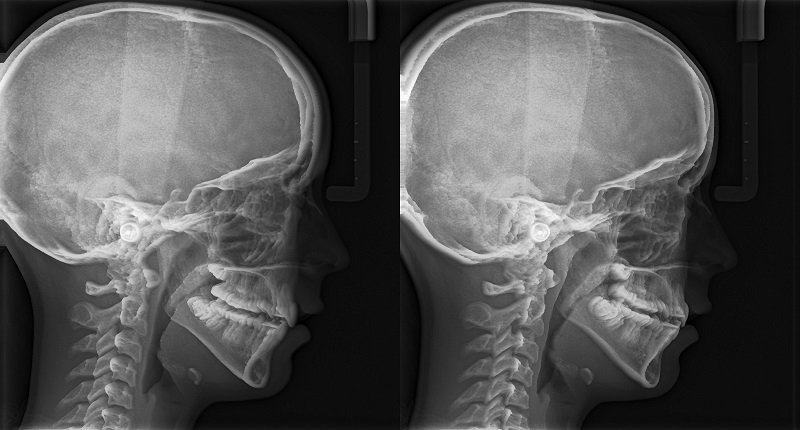 Chụp x quang sọ có phát hiện u não không