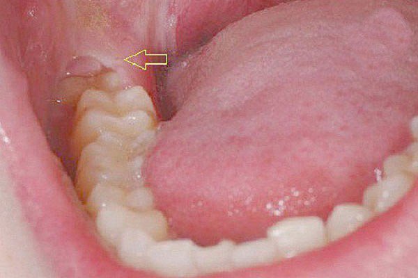 Răng khôn mọc lệch ra má có thể gây ra những vấn đề gì?
