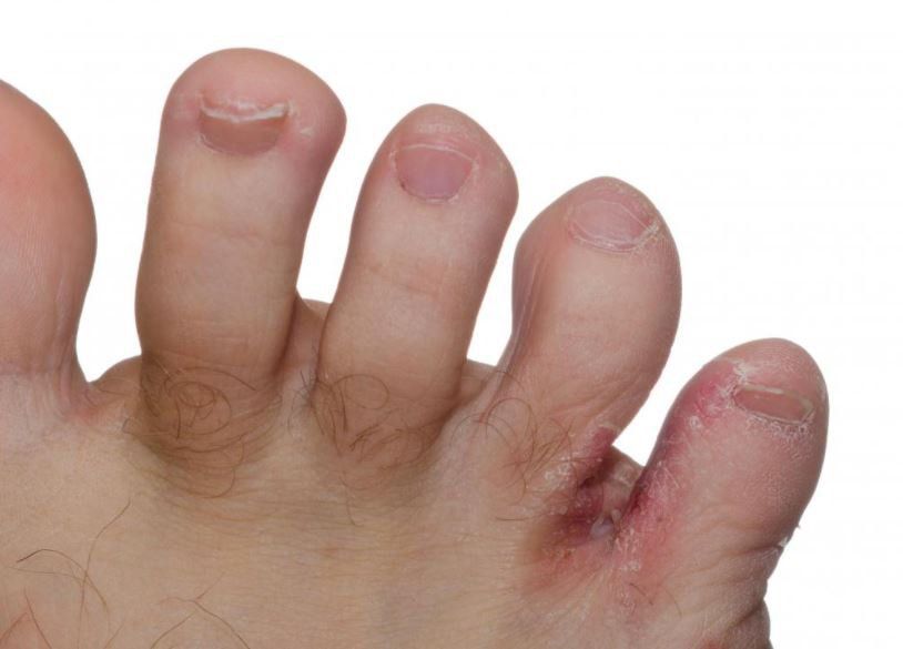 Thuốc Fungoid-D: Công dụng, chỉ định và lưu ý khi dùng