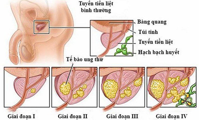 Thuốc Erleada: Công dụng, chỉ định và lưu ý khi dùng