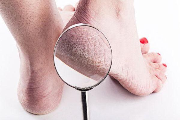 Chăm sóc và chữa nứt gót chân tại nhà