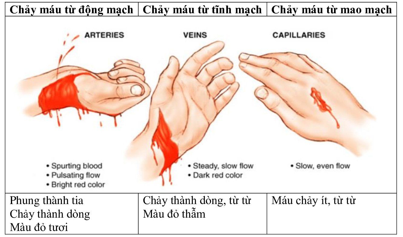 Sơ cứu chảy máu (cầm máu): Những điều cần biết