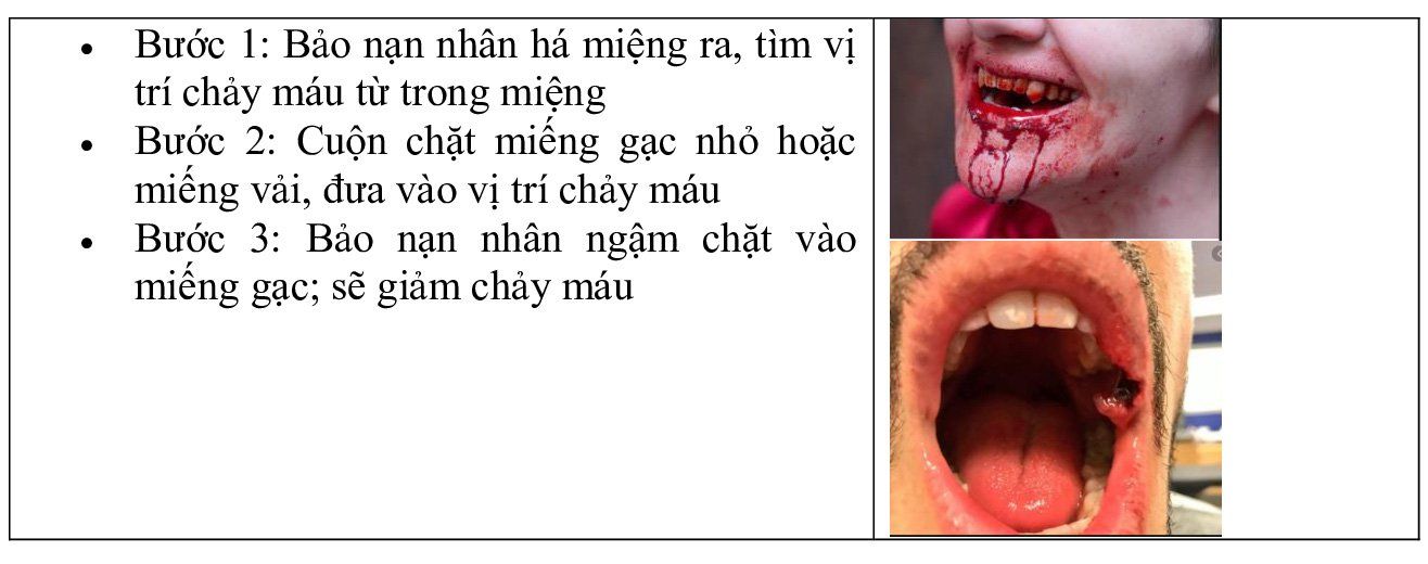 Sơ cứu chảy máu (cầm máu): Những điều cần biết