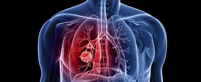 Tìm hiểu về bệnh lý tăng áp phổi