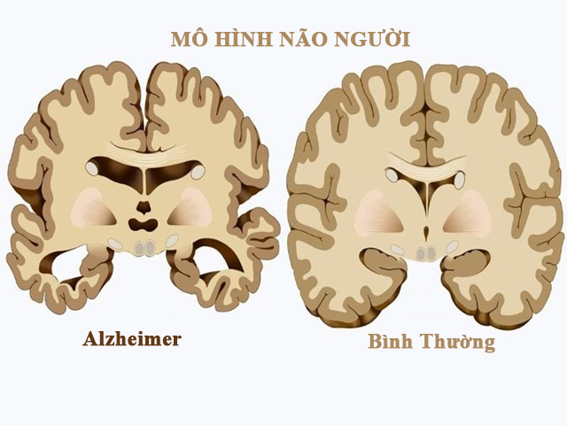 Vai trò của chất béo chuỗi trung bình trong bệnh lý tim mạch và thần kinh