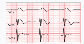 Những câu hỏi thường gặp về Hội chứng Brugada