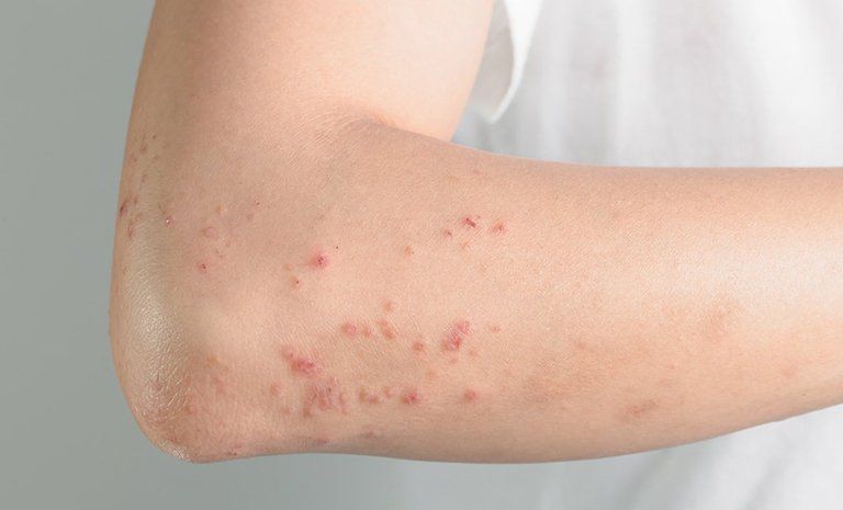 Thuốc Lovastatin: Công dụng, chỉ định và lưu ý khi dùng