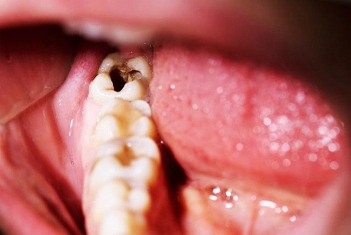 Thuốc Stannous Fluoride: Công dụng, chỉ định và lưu ý khi dùng