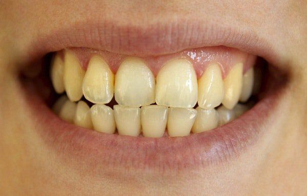 Thuốc Stannous Fluoride: Công dụng, chỉ định và lưu ý khi dùng