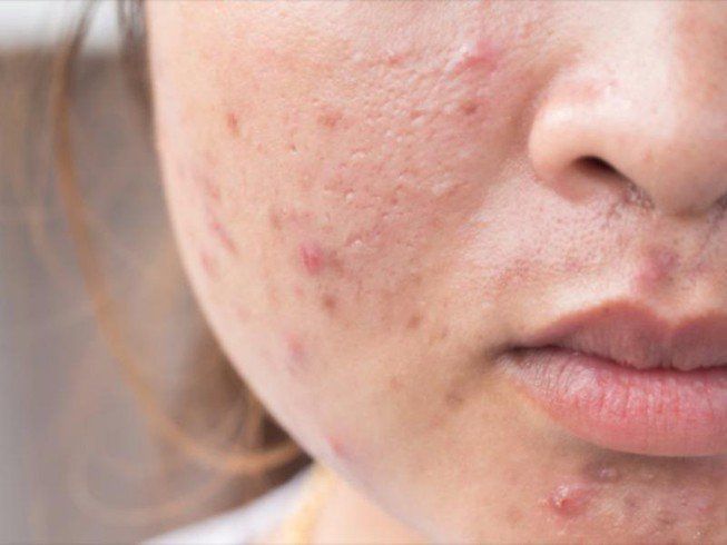 Thuốc vibramycin: Công dụng, chỉ định và lưu ý khi dùng