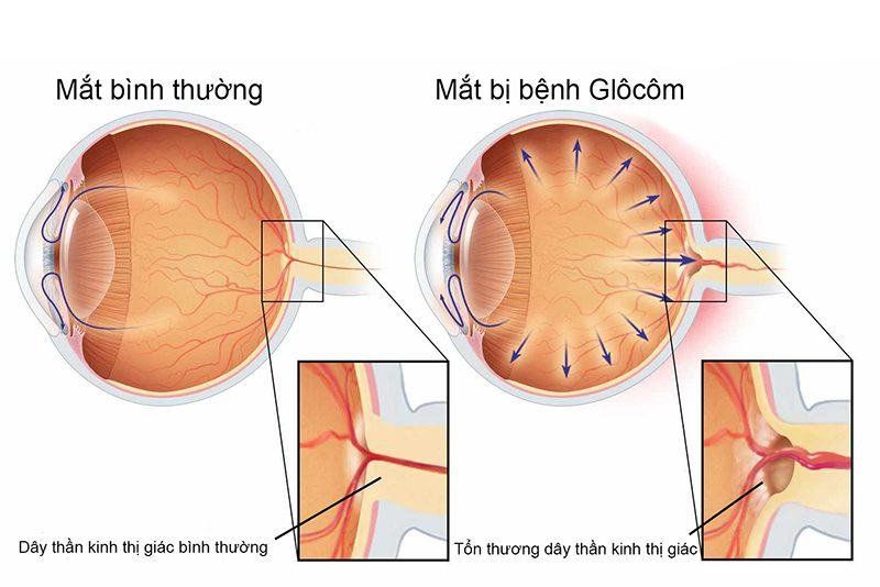 Thuốc Pexeva: Công dụng, chỉ định và lưu ý khi dùng