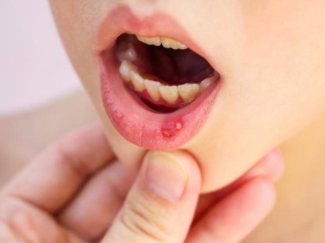 Thuốc Zilactin-B: Công dụng, chỉ định và lưu ý khi dùng