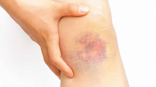 Thuốc Vinorelbine: công dụng, chỉ định và lưu ý khi dùng